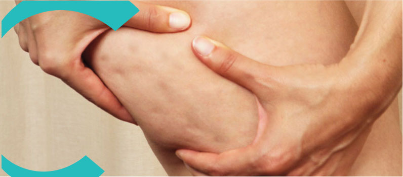 Celulitis en el cuerpo